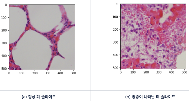 염증이 나타난 폐 병리조직 슬라이드를 찾아낼 수 있을까?